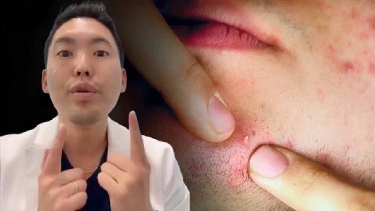 Harvard Mezunu Dermatolog Uyarıyor: Sivilceler ve Lekeler Uzun Süre Kalıyorsa Cilt Kanserinin Habercisi Olabilir