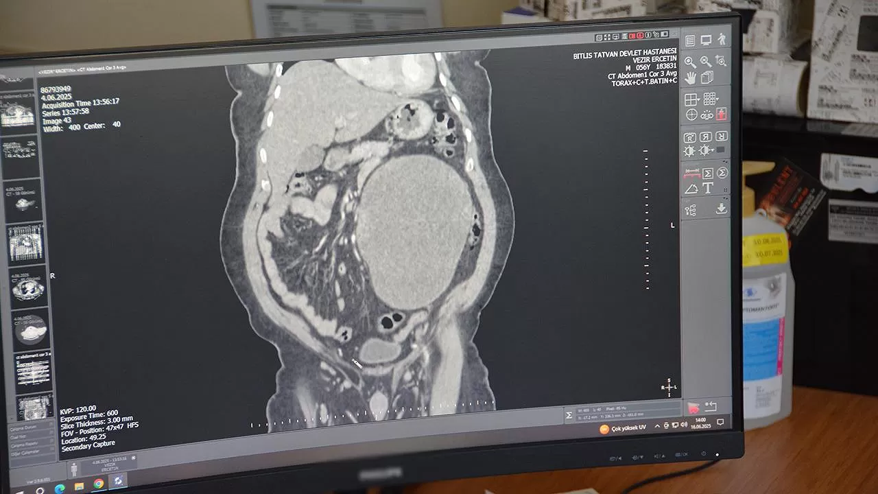 Hastaneye karın ağrısı şikayetiyle gitti böbreğinden 23 santimlik dev kist başarılı bir operasyonla çıkarıldı!