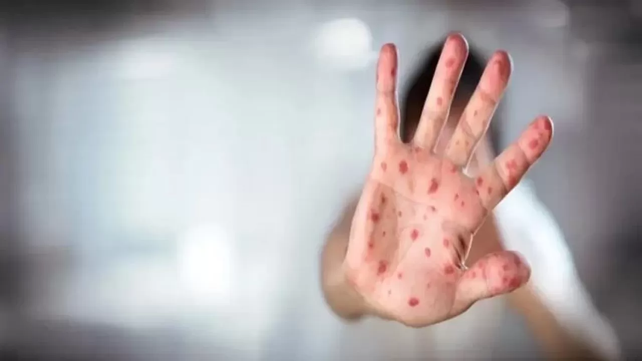 ABD’de Kızamık Vakaları Artıyor: 500 Kişiye Ulaştı