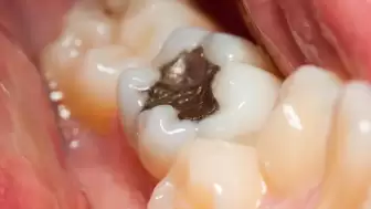 Metal Dolgu ve İmplant Kullananlar İçin Tehlike Yaratabilecek Yeni Madde Keşfedildi!