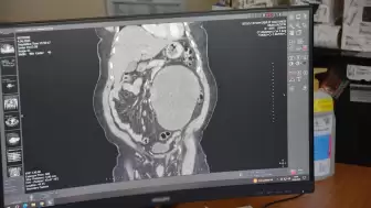 Hastaneye karın ağrısı şikayetiyle gitti böbreğinden 23 santimlik dev kist başarılı bir operasyonla çıkarıldı!