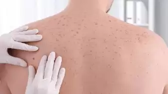 Uzmanlar cilt kanseri vakaları gün geçtikçe arttığını söylüyor. Peki cilt kanserinden korunma yolları nelerdir?