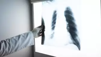 2-3 Haftadan Uzun Süren Öksürüğe Dikkat! Tüberküloz Tehdidi Sürüyor