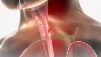 Yemek borusu kanserinde hayat kurtaran adım: Erken teşhis tedavinin anahtarı!