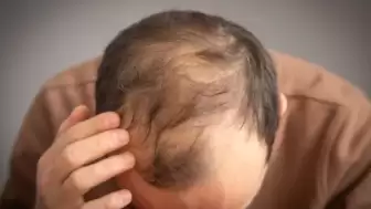 Erkeklerde saç dökülmesini hızlandıran içecekler belli oldu