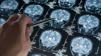 Alzheimer ile Mücadelede Kritik Veri: Hastalığın Patolojik Başlangıç Yaşı Yeniden Tanımlanıyor