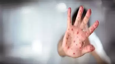 ABD’de Kızamık Vakaları Artıyor: 500 Kişiye Ulaştı