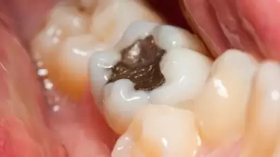 Metal Dolgu ve İmplant Kullananlar İçin Tehlike Yaratabilecek Yeni Madde Keşfedildi!