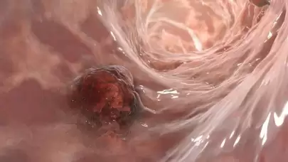 Türkiye'nin Obezite Endeksindeki Durumu Şaşırttı: Her 1 Kilo Ekstra, Yüzde 9 Risk Artırıyor!