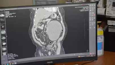 Hastaneye karın ağrısı şikayetiyle gitti böbreğinden 23 santimlik dev kist başarılı bir operasyonla çıkarıldı!