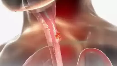 Yemek borusu kanserinde hayat kurtaran adım: Erken teşhis tedavinin anahtarı!