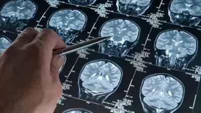 Alzheimer ile Mücadelede Kritik Veri: Hastalığın Patolojik Başlangıç Yaşı Yeniden Tanımlanıyor