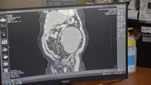 Hastaneye karın ağrısı şikayetiyle gitti böbreğinden 23 santimlik dev kist başarılı bir operasyonla çıkarıldı!