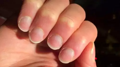 Tırnaklardaki Değişimler Sağlık Sorunlarının Habercisi Olabilir