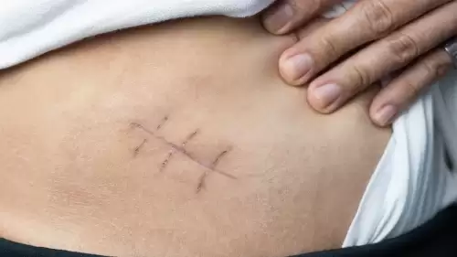 Vücutta Neşter İzi Yok: Kadın Hastalıklarında “V-NOTES” Dönemi Başladı(kardeş haber)