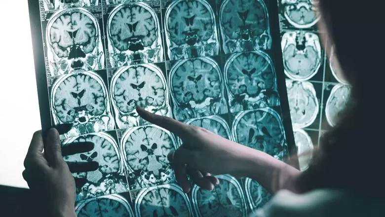 ALS hastası olan bir kişiye beyin implantı takıldıktan sonra mucizevi bir gelişme yaşandı. Artık şarkı söylemeye başlayan hastanın hikayesi şaşırtıyor!