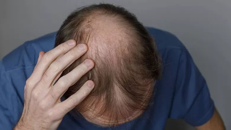 Saç dökülmesinde yeni dönem: Yüzde 82 başarı sağlayan "TH07 tedavisi"