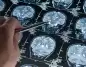 Alzheimer ile Mücadelede Kritik Veri: Hastalığın Patolojik Başlangıç Yaşı Yeniden Tanımlanıyor