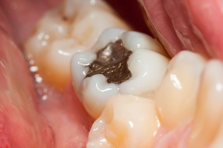 Metal Dolgu ve İmplant Kullananlar İçin Tehlike Yaratabilecek Yeni Madde Keşfedildi!