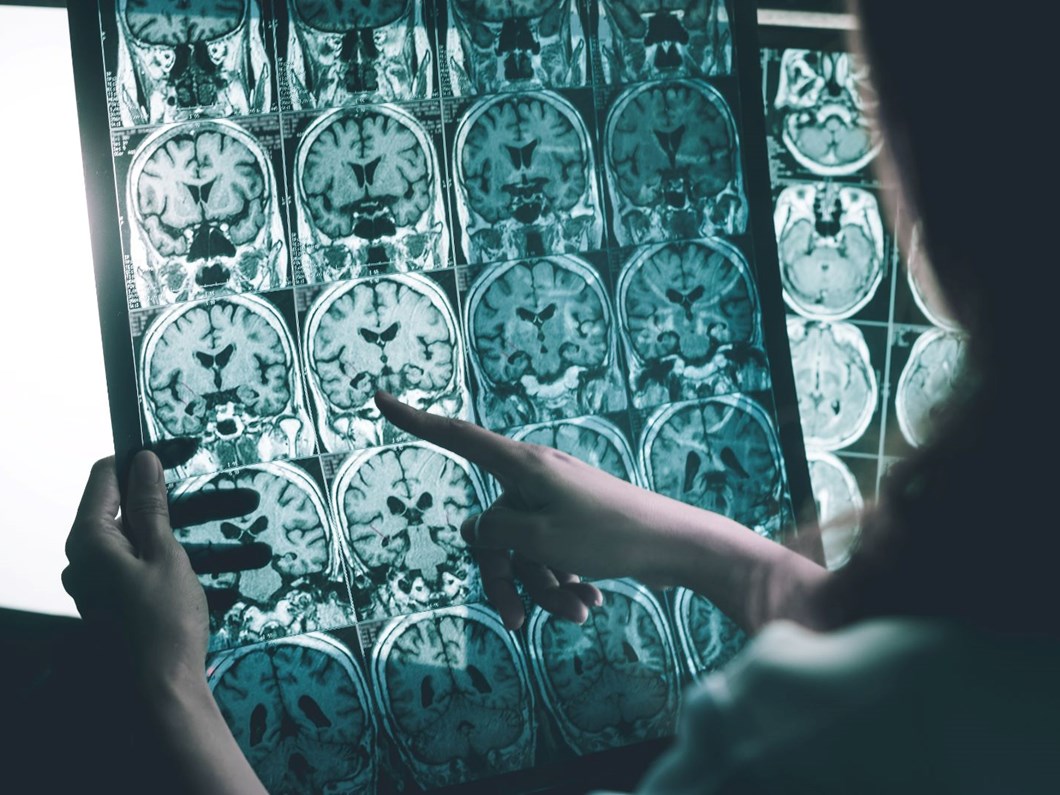 ALS hastası olan bir kişiye beyin implantı takıldıktan sonra mucizevi bir gelişme yaşandı. Artık şarkı söylemeye başlayan hastanın hikayesi şaşırtıyor!