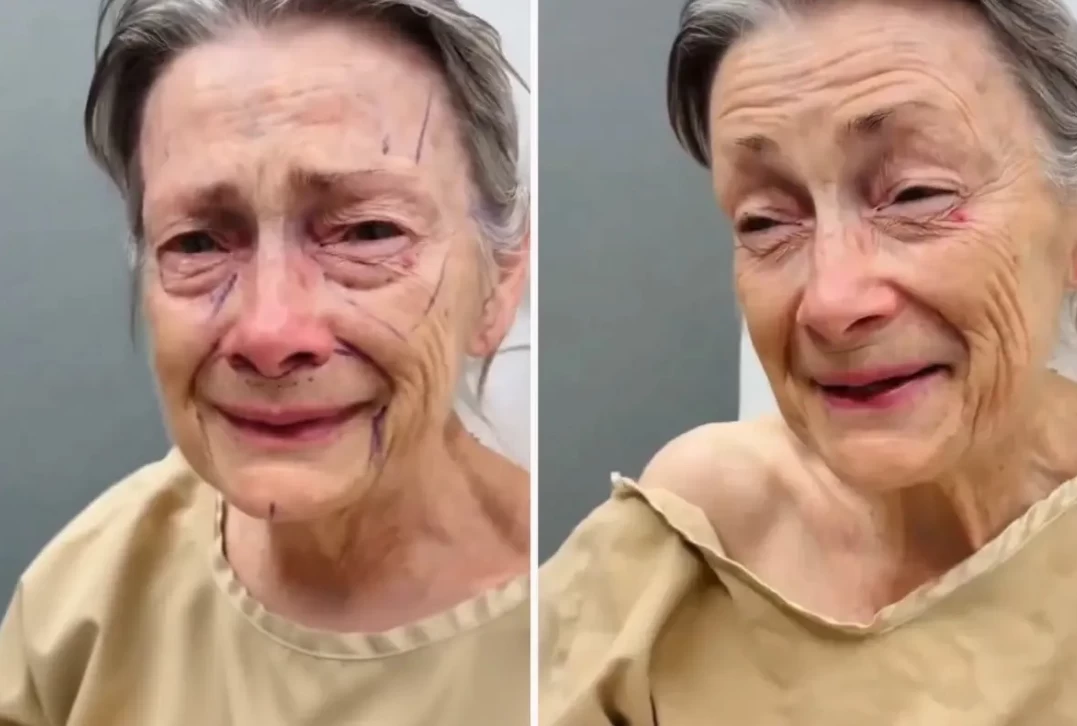 Yurt dışında bir kadın, yüzüne yaptırdığı estetik operasyonu sonrası adeta başka bir insana dönerek gençleşti