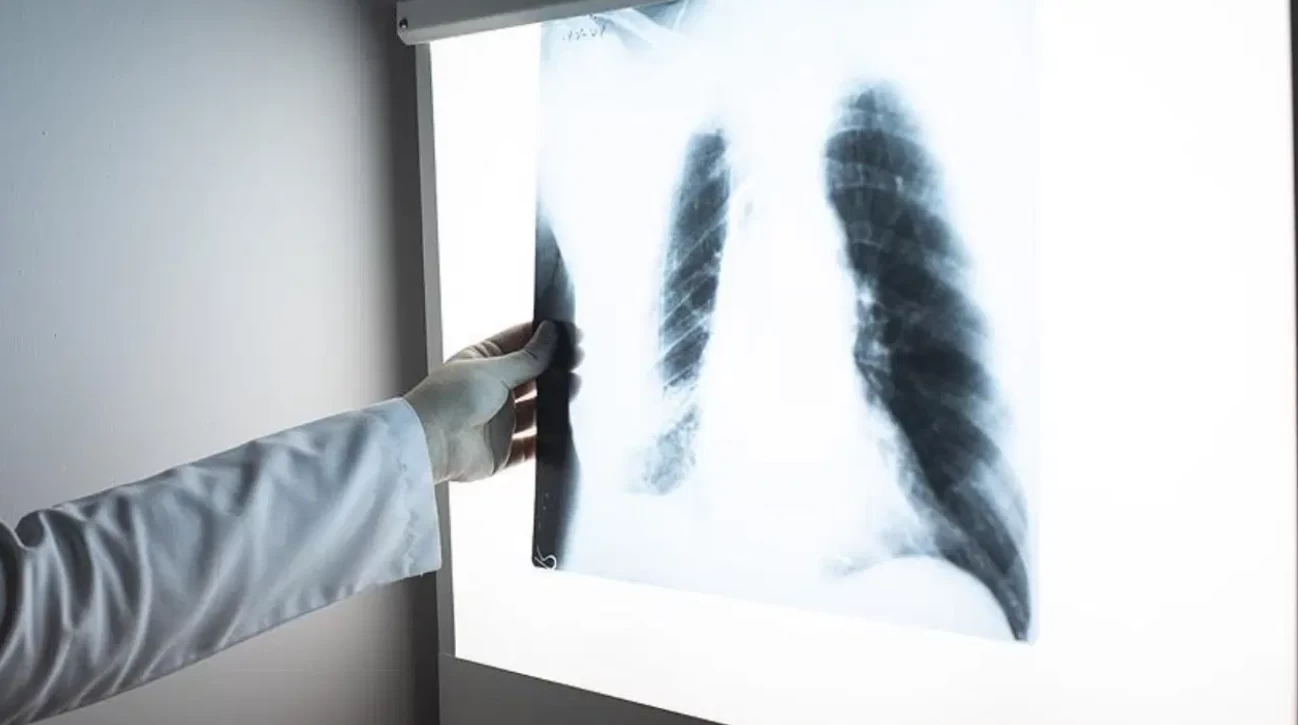 2-3 Haftadan Uzun Süren Öksürüğe Dikkat! Tüberküloz Tehdidi Sürüyor