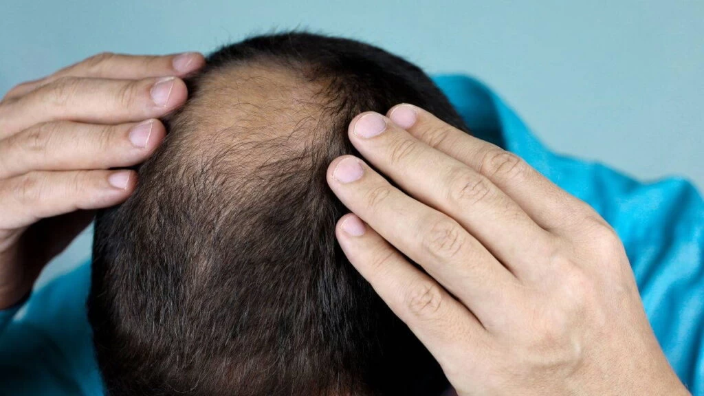 Kellik Gerçekten Genetik mi? Araştırmalar Yeni Detayları Ortaya Koyuyor