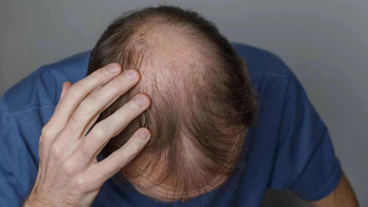 Saç dökülmesinde yeni dönem: Yüzde 82 başarı sağlayan "TH07 tedavisi"