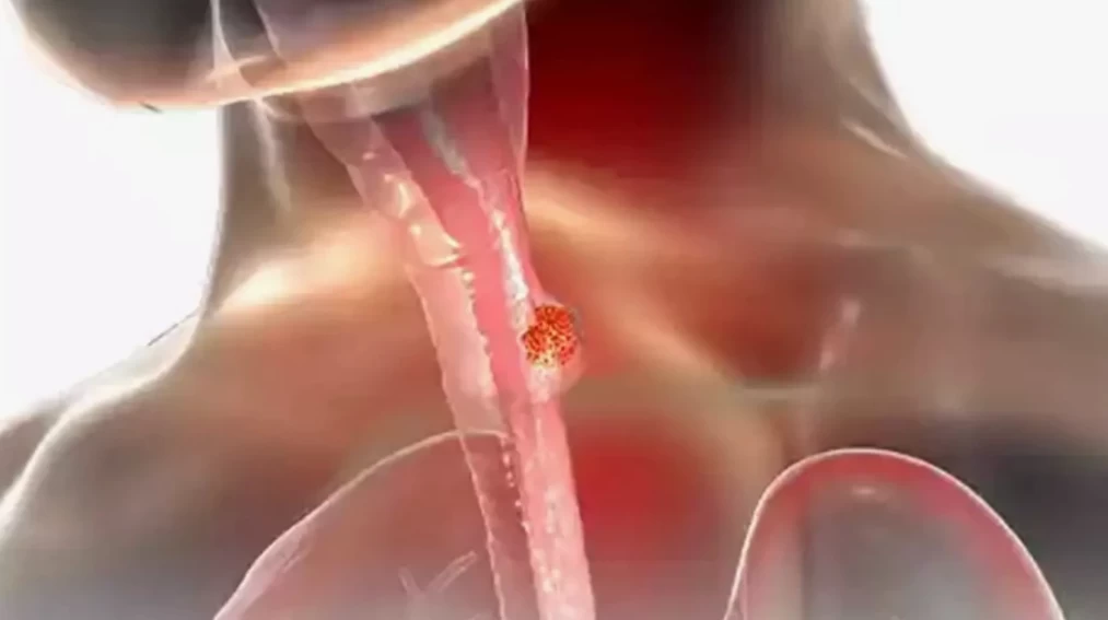 Yemek borusu kanserinde hayat kurtaran adım: Erken teşhis tedavinin anahtarı!