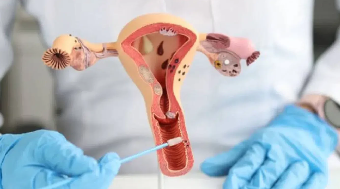 Sessiz tehlike endometriozis: Organ yetmezliği ve kısırlık riskine yol açıyor