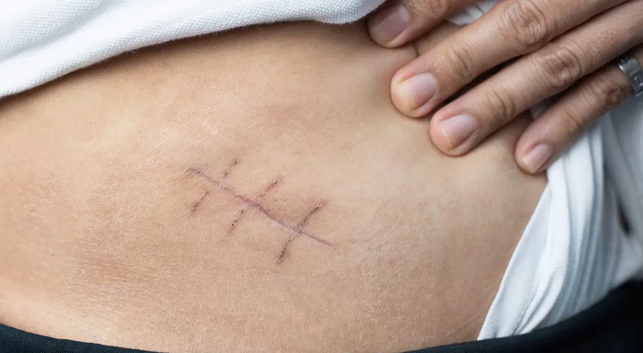 Vücutta Neşter İzi Yok: Kadın Hastalıklarında “V-NOTES” Dönemi Başladı(kardeş haber)