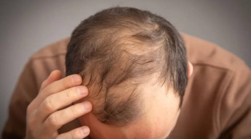 Erkeklerde saç dökülmesini hızlandıran içecekler belli oldu