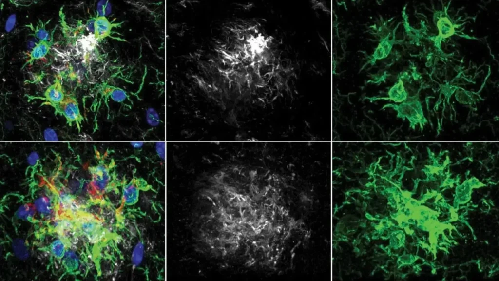Bilim İnsanlarından Alzheimer’a Karşı Beynin Savunma Sistemini Hedefleyen Yeni Strateji