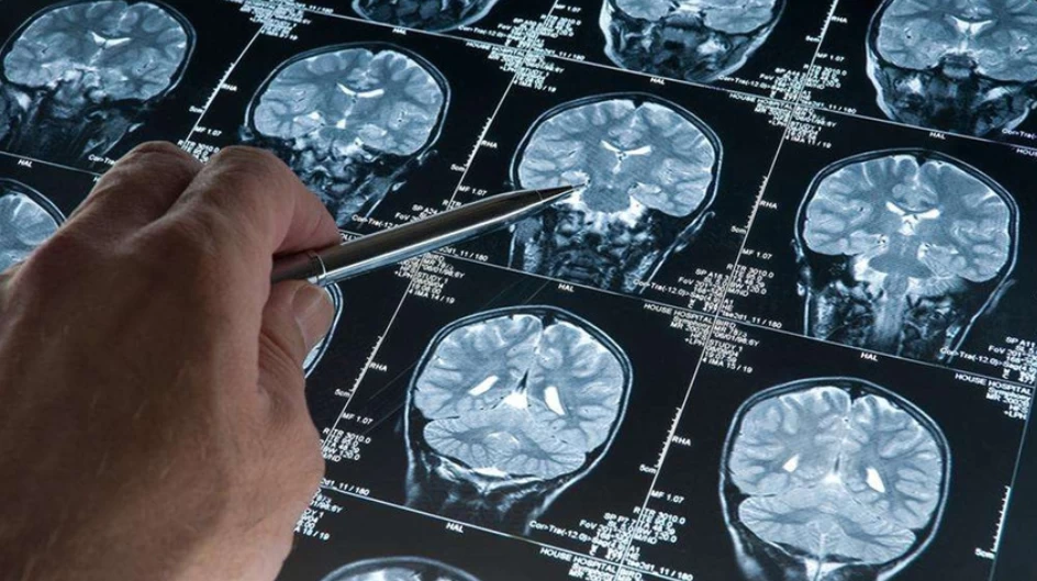 Alzheimer ile Mücadelede Kritik Veri: Hastalığın Patolojik Başlangıç Yaşı Yeniden Tanımlanıyor